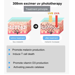 Equipo de Fototerapia UV Kernel CN 308B con <span class=keywords><strong>Luz</strong></span> Excimer LED de 308nm para el Tratamiento del Vitiligo y la Psoriasis - Product Image 4