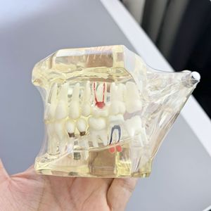Modèle de restauration d'implant dentaire M2001, modèle de pathologie dentaire en silicone médical transparent pour exposition scientifique médicale - Product Image 2