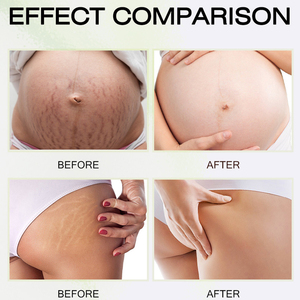 Crema Facial Efectiva para <span class=keywords><strong>Eliminar</strong></span> Cicatrices, Acné, Espinillas y Estrías, Crema Suavizante y Reafirmante, Crema Reparadora de Cicatrices y Estrías - Product Image 6
