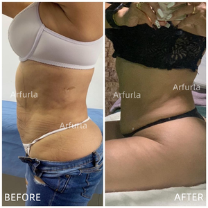 Máquina de Lipólisis con Resultados Efectivos, 980nm 1470nm, Máquina Endoláser de Alta Potencia, Lifting Facial, Lipólisis Láser, Máquina de Liposucción - Product Image 6