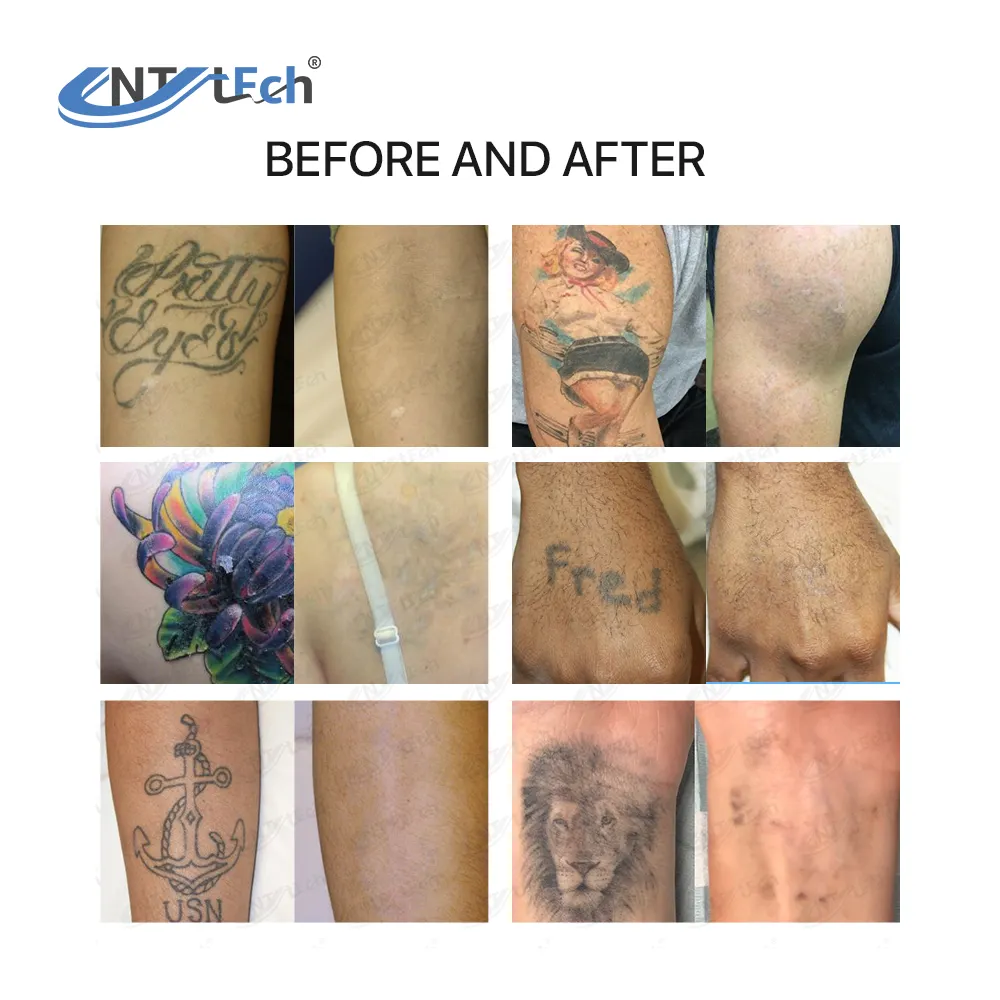 Máquina de remoção de tatuagem a laser comutado q picossegundos para nd yag aprovada pela CE
