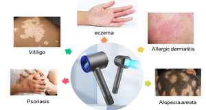 نظام ضوء الليزر LED بطول موجة 308 نانومتر من Peninsula لعلاج الصدفية والبهاق بالمعالجة الضوئية - Product Image 5