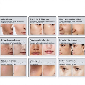 Máquina de Hidrodermoabrasión Profesional 2026, Fabricante de Equipos Faciales, Oxígeno Jet, Cuidado de la Piel, Aqua Peel, Hidro Belleza - Product Image 4