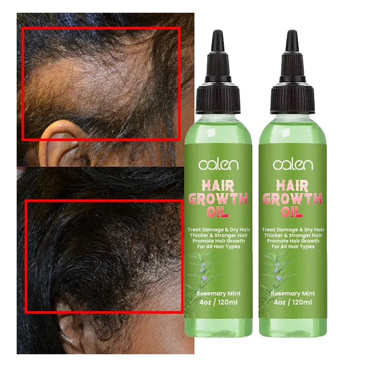 Oalen Hair Care Mejora el crecimiento del cabello Nutritivo Saver Aliviar la tensión Refrescante Menta Aceite para el cabello del cuero cabelludo