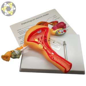 แบบจำลองกายวิภาคศาสตร์ของเนื้องอกมดลูกในผู้หญิง แบบจำลองกายวิภาคศาสตร์ของมดลูก - Product Image 5