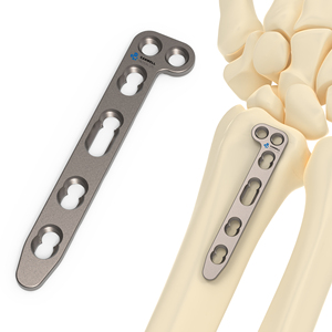 CANWELL Placca a L in Titanio per Fissaggio Dorsale del Radius Distale, Impianto Ortopedico per Frattura Ossea con 2 Punti di Fissaggio CE ISO - Product Image 1
