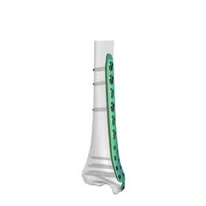 Sistem Implan Fiksasi Fraktur Tulang Pelat Pengunci Trauma Bedah Ortopedi Titanium untuk Tulang Humerus, Femur, Tibia, dan <span class=keywords><strong>Radius</strong></span> - Product Image 4