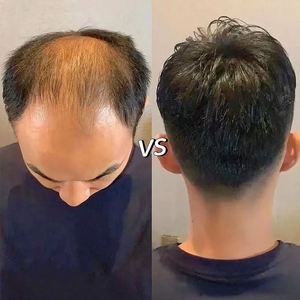Prótesis Capilar Masculina de Cabello Humano Natural de 6 Pulgadas de Largo, con Base Mono, para Hombres - Product Image 5