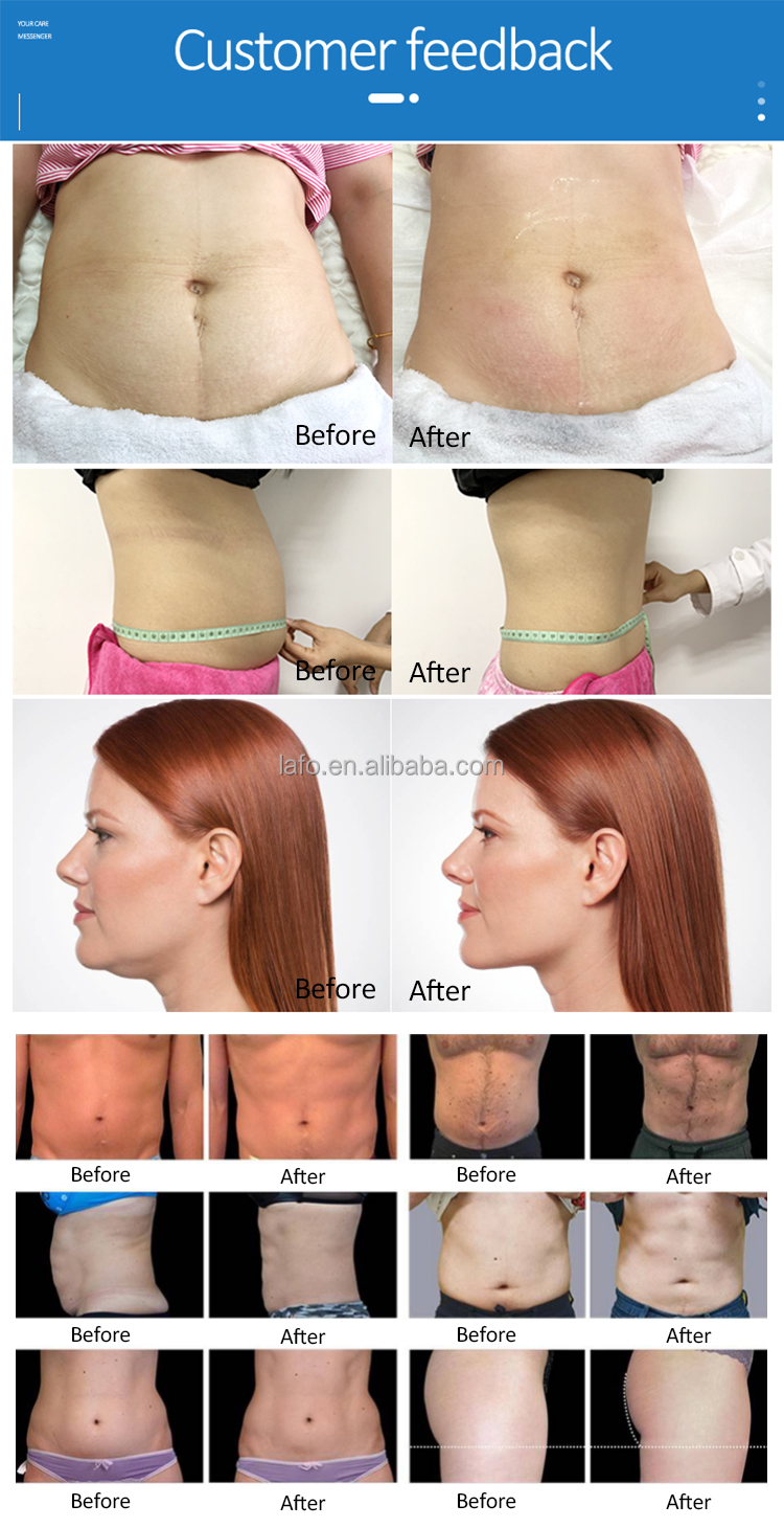 Newest portable 2 cryo handles 360 cryolipolysis machine for body slimming double chin removal