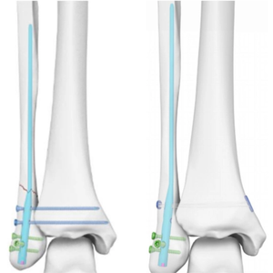 Tornillo de Bloqueo Distal y <span class=keywords><strong>Proximal</strong></span> para Clavo Intramedular de Titanio - Product Image 6