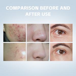 Nueva Versión Mejorada 7 en 1, Máquina Multifunción de Hidrodermoabrasión, Peeling Facial con Agua y Oxígeno, Máquina de Burbujas Pequeñas para el Cuidado de la Piel - Product Image 6