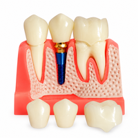 Modèle d'implant dentaire pédagogique, modèle détachable de couronne dentaire et de visqueuse pour la formation des dentistes et l'affichage en clinique