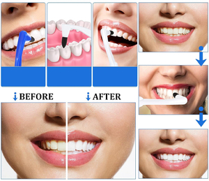 Barre de nettoyage <span class=keywords><strong>dentaire</strong></span> en plastique YuLin YL pour éliminer les taches et le tartre avec brosse pour le détartrage - Vente en gros depuis Henan - Product Image 6