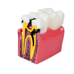 Modello Comparativo di Denti con 6 Volte Più Danni, Modello di Denti in Resina Dentale Smontabile - Product Image 2