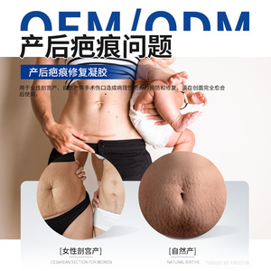 Gel OEM para la reparación de cicatrices posparto 15g para mujeres, crema corporal para el cuidado de cesáreas, prevención y reparación de estrías - Product Image 5