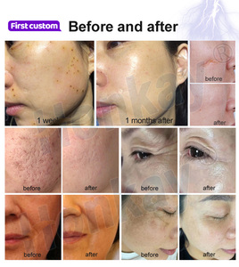 Machine de beauté au <span class=keywords><strong>plasma</strong></span> chaud et froid 9 en 1, logo personnalisé exclusif à l'usine, régule la sécrétion d'huile, <span class=keywords><strong>plasma</strong></span> chaud - Product Image 6