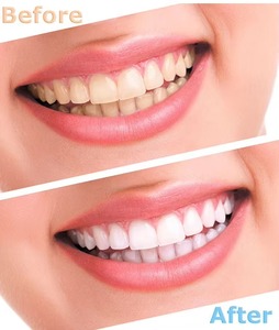 Kit de Blanqueamiento Dental con Luz LED, Kit Profesional de Blanqueamiento Dental con Geles para Dientes Sensibles, Ayuda a Eliminar Manchas - Product Image 2