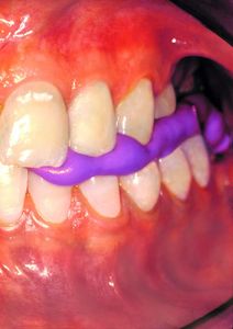 Prezzo di fabbrica Kit di registrazione del morso all'ingrosso miglior polietere dentale in Silicone impressione stucco