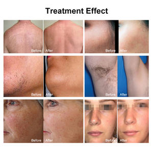 Épilation sans chirurgie pour salon de beauté, populaire, portable, best-seller, 2026 - Product Image 6