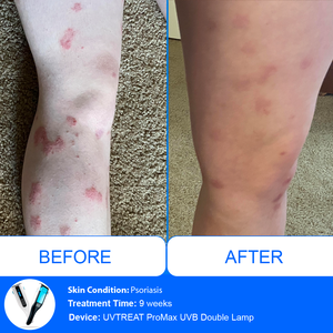 Inalámbrico UVB 311 nm Kernel Uvb KN-4006BL1D portátil hogar médico Uvb lámpara Vitiligo para tratamiento de psoriasis lámpara Uvb <span class=keywords><strong>amazon</strong></span> - Product Image 3