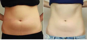 Máquina de eliminación de grasa corporal Vaser lipólisis longitud de onda dual 980nm1470nm Láser de Diodo liposucción endoláser estiramiento <span class=keywords><strong>facial</strong></span> y de cuello - Product Image 6