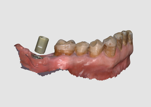 Scanbody cho kỹ thuật số nha khoa ấn tượng quét mô hình cơ thể intraoral - Product Image 5