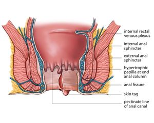 Máquina de Tratamiento de Hemorroides con Láser de Diodo de 980nm para Fístula <span class=keywords><strong>Anal</strong></span> y Hemorroides - Product Image 5