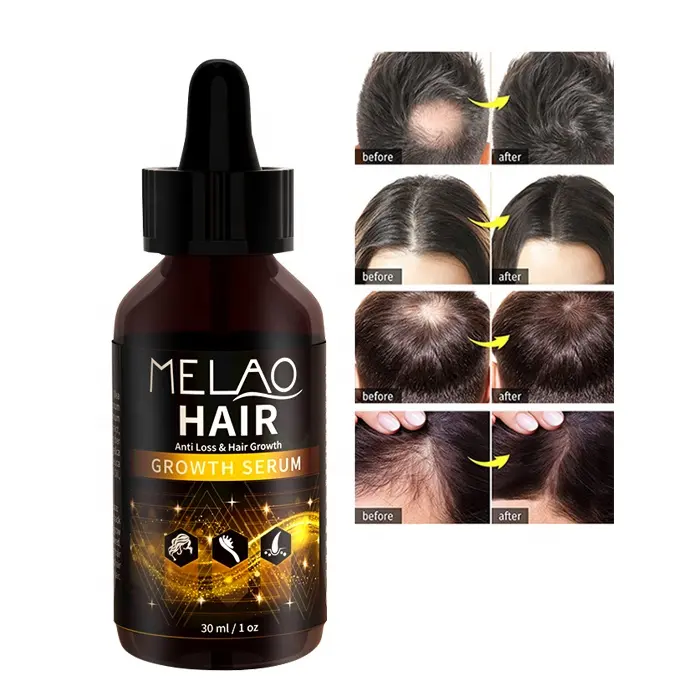 Vendita calda 30ml Private Label Natural Organic promuove l'olio di siero per la crescita rapida dei capelli allo zenzero per l'olio per la crescita dei capelli di uomo e donna