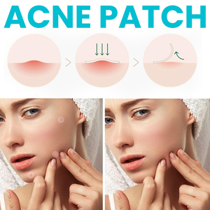 Nouveaux patchs hydrocolloïdes ronds pour l'acné, marque privée, patchs anti-acné au curcuma motif chat mignon, vente en gros de patchs anti-boutons - Product Image 3