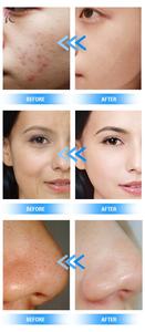 Новый дизайн насадки для очистки пор для гидродермабразии, алмазная ручка для мини-аппарата гидродермабразии - Product Image 4