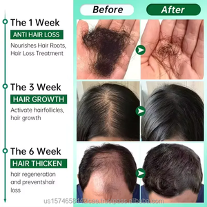 SunpinHerb Huile Essentielle de Romarin 100% Pure, Naturelle et Biologique de Qualité Supérieure pour la Croissance Capillaire, Soin de la Peau, Cheveux, Visage et Massage Corporel - Product Image 4