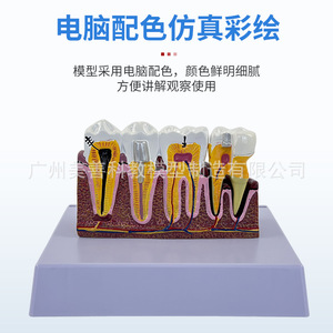 Molares ampliados 3 veces, patología dental completa, dientes transparentes, caries dentales, enseñanza de comunicación con pacientes dentales - Product Image 3