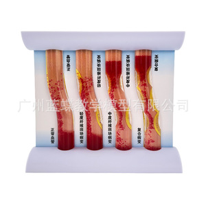 Modèle de simulation vasculaire d'occlusion et d'hyperlipidémie ; dynamiques pathologiques de l'athérosclérose et de la thrombose artérielle ; - Product Image 2