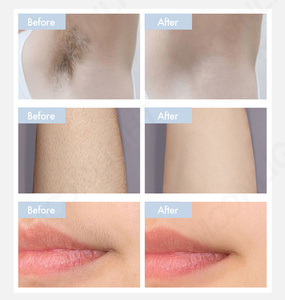 Đông Quan <span class=keywords><strong>Laser</strong></span> vẻ đẹp Cryolipolysis Giảm béo máy đỉnh thứ hai <span class=keywords><strong>Diode</strong></span> <span class=keywords><strong>laser</strong></span> và <span class=keywords><strong>Diode</strong></span> <span class=keywords><strong>Laser</strong></span> - Product Image 5