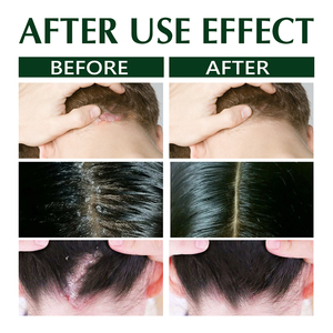 Shampoo anti-démangeaisons South Moon Tinea Capitis pour la dermatite séborrhéique, le <span class=keywords><strong>psoriasis</strong></span>, soulagement des démangeaisons et élimination des pellicules - Product Image 3