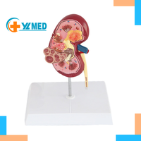 Reno normal y enfermo con perspectiva dual para patología, anatomía humana y educación CE/ISO