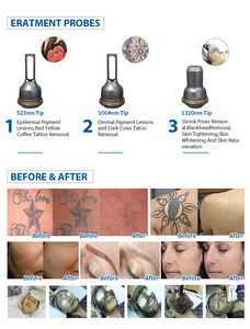 CE ha approvato la macchina di rimozione del tatuaggio del laser di <span class=keywords><strong>kes</strong></span> vendita calda q switched nd yag con la macchina del peeling del carbonio del laser 1064nm 532nm - Product Image 3