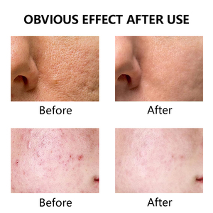 Pads de <span class=keywords><strong>Soin</strong></span> Visage au Thé Vert à Marque Blanche à la Centella pour le Traitement de l'Acné et l'Élimination des Imperfections - Masque Visage - Product Image 4