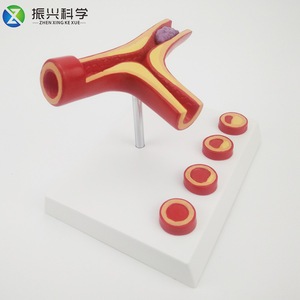 Modelo de arteria en forma de Y con aterosclerosis y trombosis, modelo educativo, suministros del fabricante. - Product Image 1