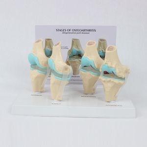 Modello di Articolazione del Ginocchio Malato a 4 Fasi per Educazione Medica con Scheda Posteriore (Materiale PVC) - Product Image 4