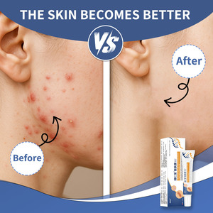 Crème antibactérienne et anti-démangeaisons à base de plantes, marque privée, pour l'eczéma, le psoriasis, le prurit, soulage les démangeaisons des mains, des pieds et des parties anales, vente en gros OEM - Product Image 4