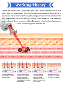 Équipement <span class=keywords><strong>laser</strong></span> au thulium 1927 nm avec plusieurs modes de balayage pour l'anti-âge, l'activation du collagène et la réduction de la pigmentation - Product Image 2