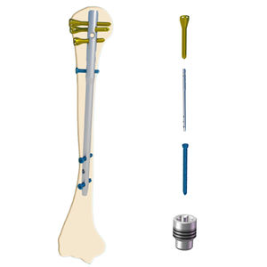 Implant Ortopedi Paduan Titanium Humerus Multidimensional Locking <span class=keywords><strong>Intramedullary</strong></span> Nail Kelas III Bersertifikat CE Ortopedi - Product Image 6