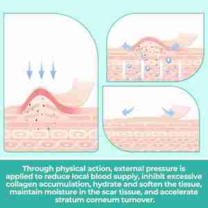 Cinta de Silicona para Cicatrices, 6 Unidades - Cinta de Silicona de Grado Médico para Cicatrices Quirúrgicas, Láminas de Silicona Reutilizables para Cicatrices de Cesárea, Cirugía - Product Image 6