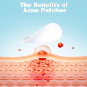 Patchs anti-acné micro-aiguilles à l'acide salicylique sous marque privée, autocollants hydrocolloïdes pour soins de la peau, patchs micro-aiguilles pour boutons - Product Image 3