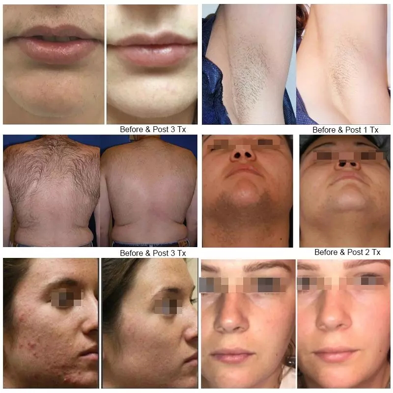 Hot Selling Suitable for All Kinds of Skin Color 808nm Diode Laser Machine For Hair Remover 808nm