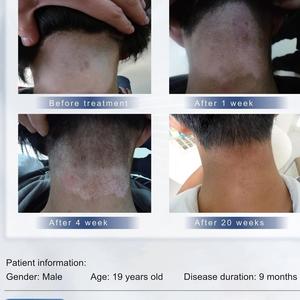 Expert Laser Excimer Máquina de 308 nm Dispositivo de fototerapia para el tratamiento del vitiligo Recuperar el pigmento de la piel LED Duración de 2000 horas de duración - Product Image 4