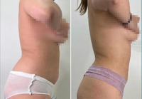 Appareil amincissant le corps élimination des graisses 980 nm Diode Laser Lipomes Machine de beauté Laser Ablation Ultrasonique 1470 Liposuccion Machine