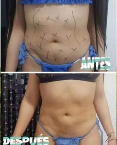 Triangel Laseev plastik cerrahi fiberlift lazer liposuction güç kanül güç kanül kolu 980nm facelifting lazer - Product Image 6