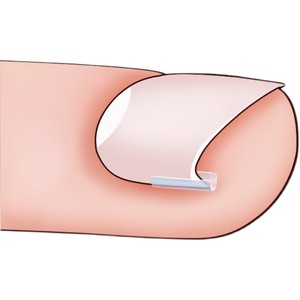Almohadilla correctora para uñas encarnadas, para niños, GLD-688 - Product Image 1